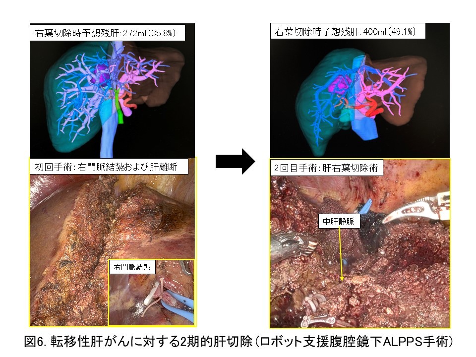 肝臓の外科: 肝切除から肝移植へ 肝細胞研究会：人工肝臓・部分肝移植・そして肝細胞脾臓内移植へ〜肝